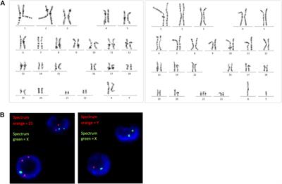 Case report: Molecular analysis of a 47,XY,+21/46,XX chimera using SNP microarray and review of literature